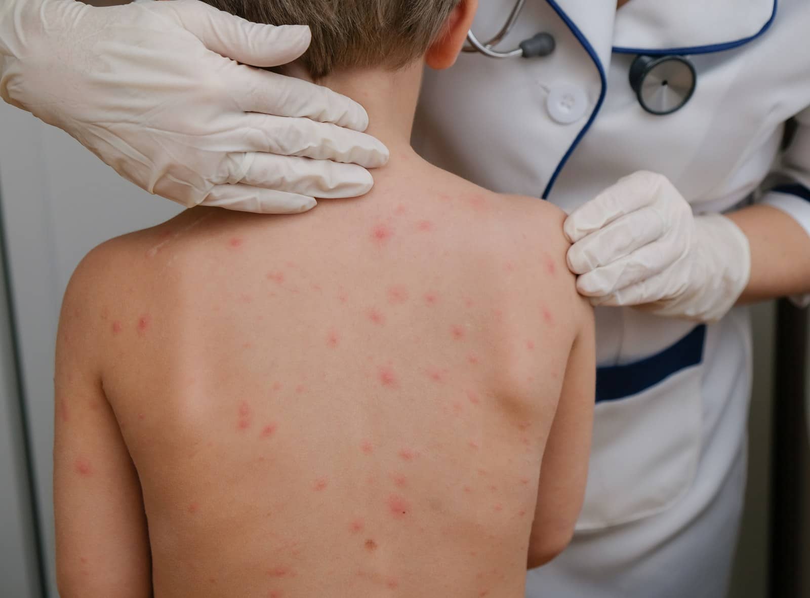 Médica de luvas examina as costas de uma criança com manchas vermelhas na pele, característica de sarampo